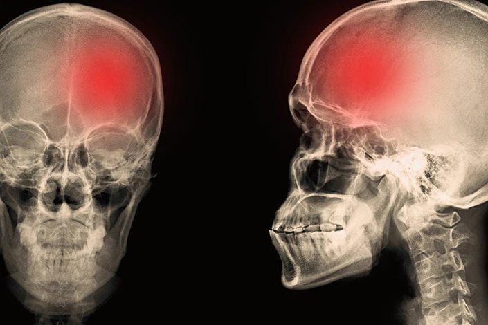 types_of_TBI_May.jpg
